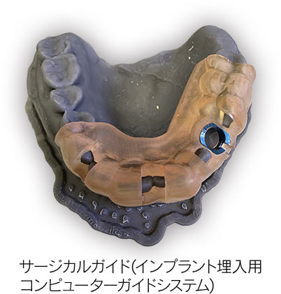 サージカルガイド(インプラント埋入用コンピューターガイドシステム)